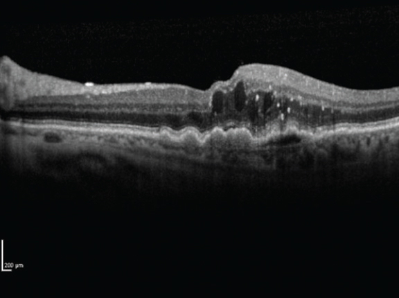 Home OCT Assessment of nAMD Comparable with Manual Grading